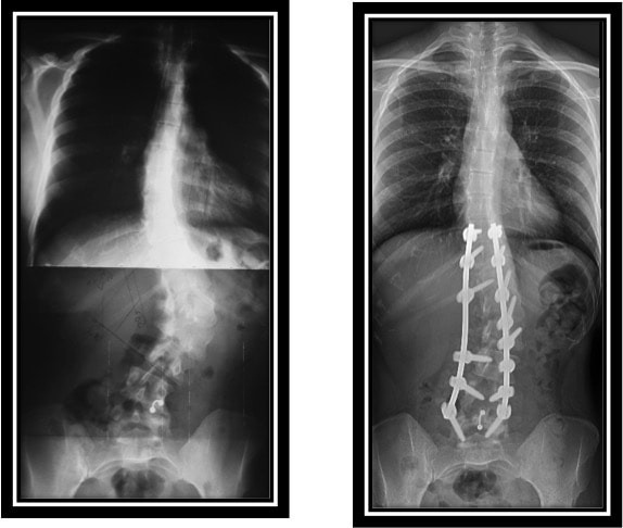 Spine Conditions